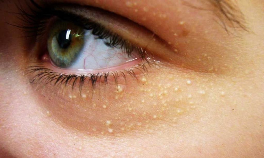 Điều trị dứt điểm u mỡ vàng ở mắt