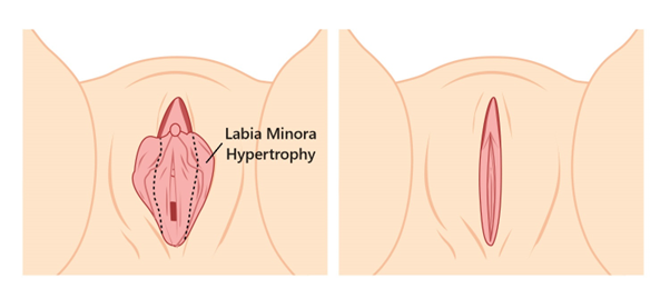 Labial minor plasty