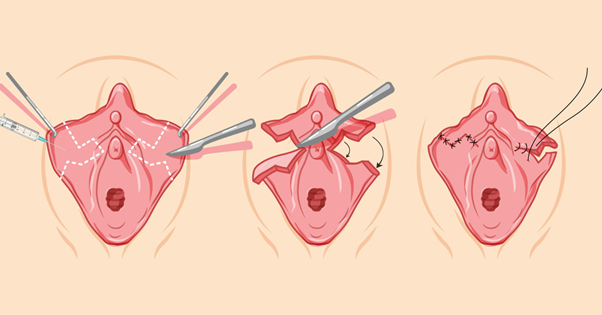 Labial minor plasty