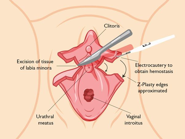 Labial minor plasty