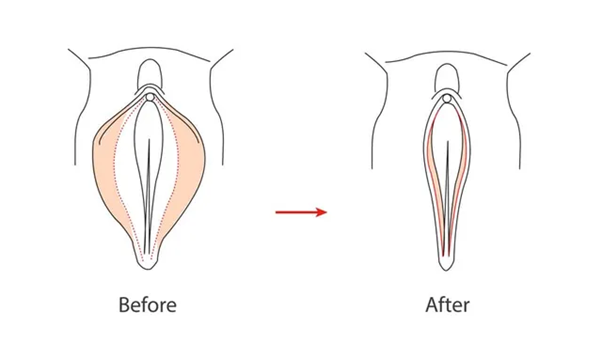 Labial minor plasty