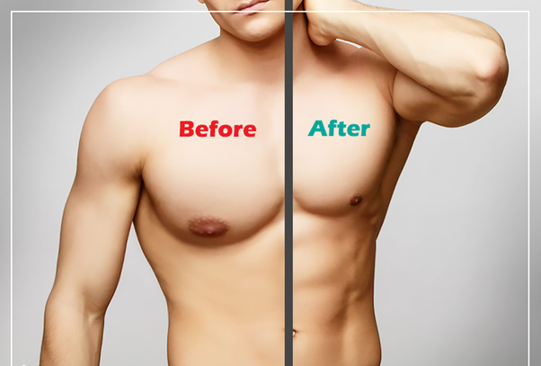 Gynecomastia for man