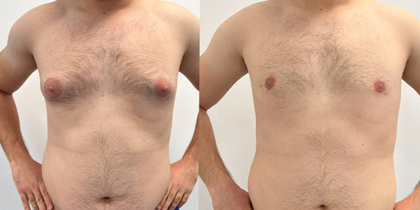 Gynecomastia for man