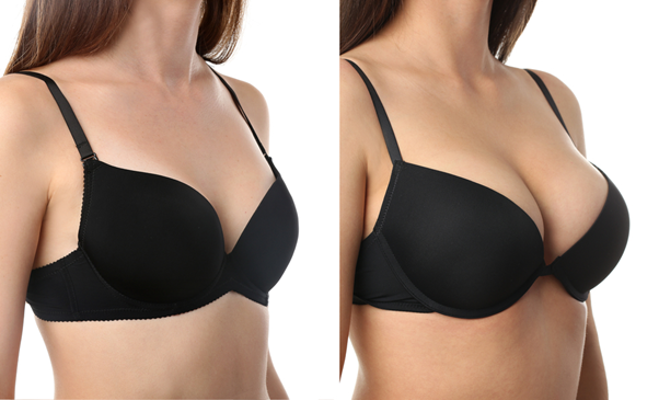 Breast augmentation