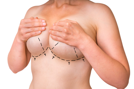 Breast mastopexy