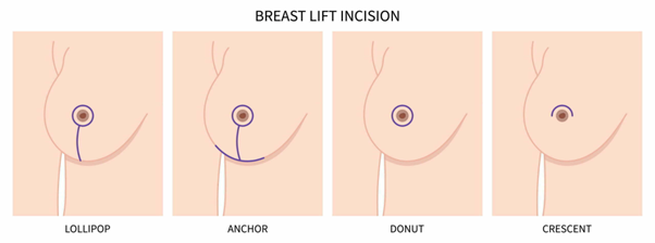 Breast mastopexy