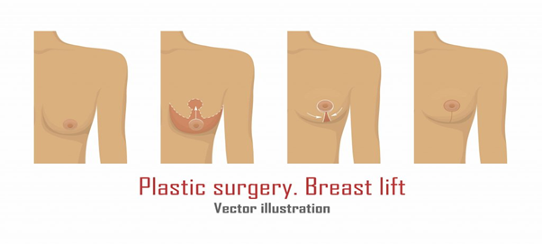 Breast mastopexy