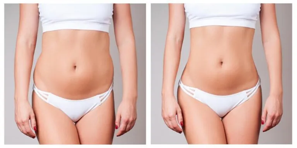 Abdomminal liposuction