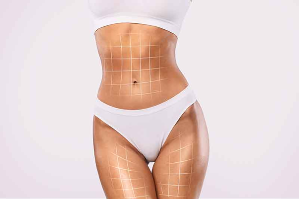 Abdomminal liposuction