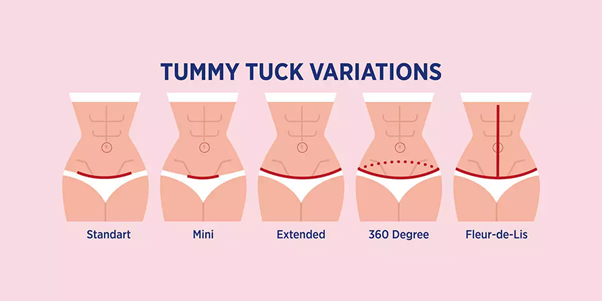 Tummy tuck