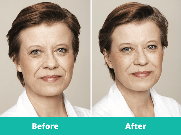 Removal wrinkles Face by Botilium toxin