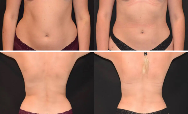 Stomach Liposuction