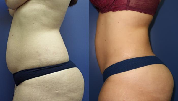 Stomach Liposuction