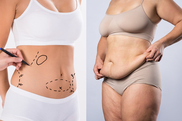 Stomach Liposuction