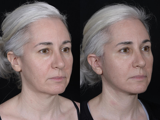 Deep plane facelift vs. Traditional method: Which is right for You?