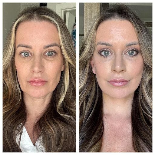 Deep plane facelift vs. Traditional method: Which is right for You?