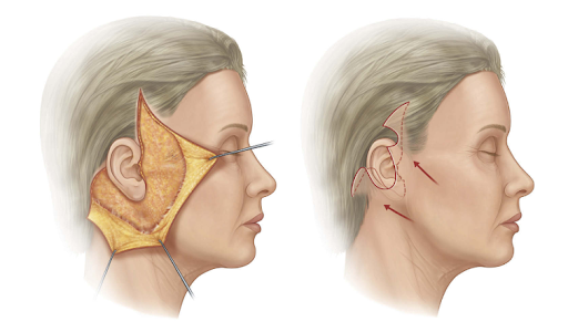 Deep plane facelift vs. Traditional method: Which is right for You?