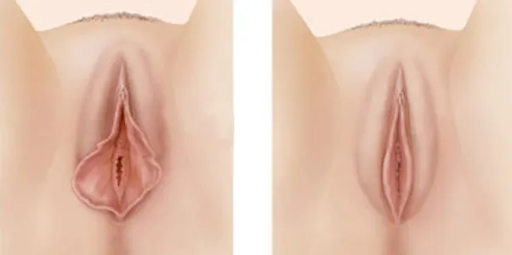 Minor labial plasty - Understanding the procedure and benefits 