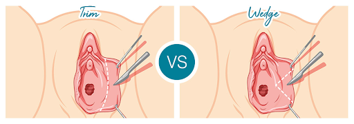 Minor labial plasty - Understanding the procedure and benefits 