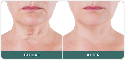 Before and After: Real results of Neck Lift procedures