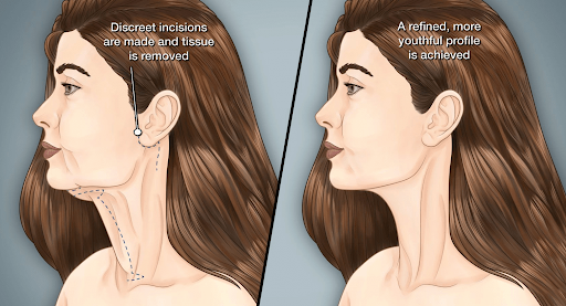 Before and After: Real results of Neck Lift procedures