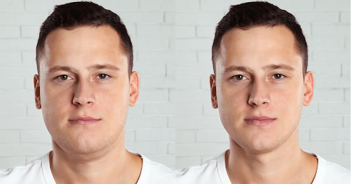 Chin and Jawline liposuction: Sculpting the perfect profile - Does it leave scars?