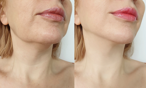 Chin and Jawline liposuction: Sculpting the perfect profile - Does it leave scars?