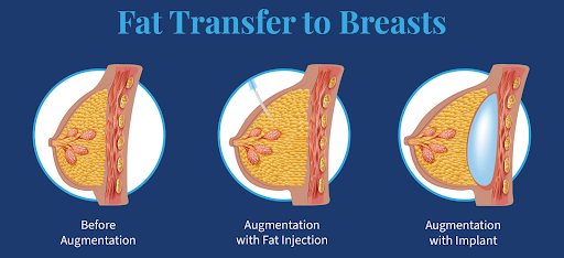 How many sessions are needed for breast augmentation by fat graft ?