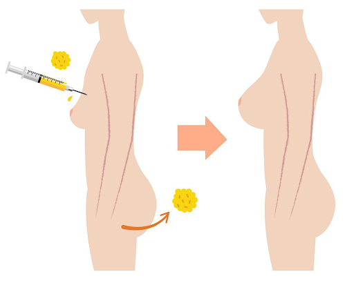 How many sessions are needed for breast augmentation by fat graft ?