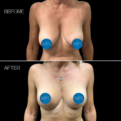 Top FAQs about breast lift recovery and results
