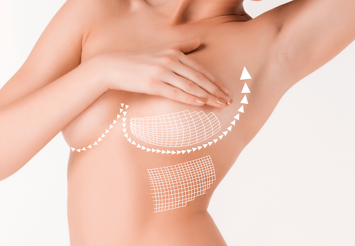 Top FAQs about breast lift recovery and results