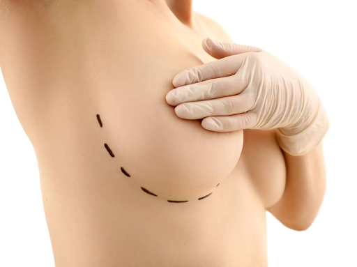 Top FAQs about breast lift recovery and results