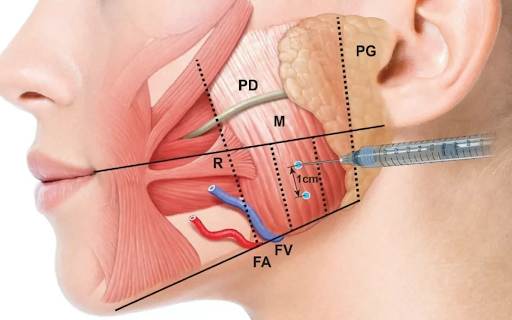 What to expect after masseter botox injections: Timeline & Side effects