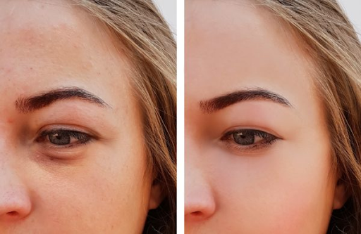 No more tired eyes: How under-eye fat transfer rejuvenates your look ?