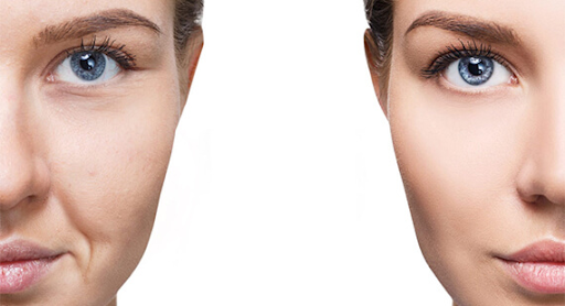 No more tired eyes: How under-eye fat transfer rejuvenates your look ?