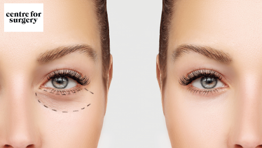 Trifecta Blepharoplasty: A comprehensive solution