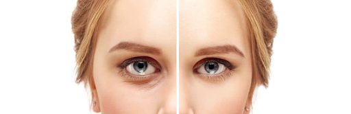 Trifecta Blepharoplasty: A comprehensive solution