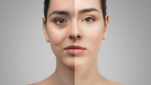 Trifecta Blepharoplasty: A comprehensive solution