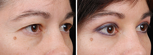 Trifecta Blepharoplasty: A comprehensive solution