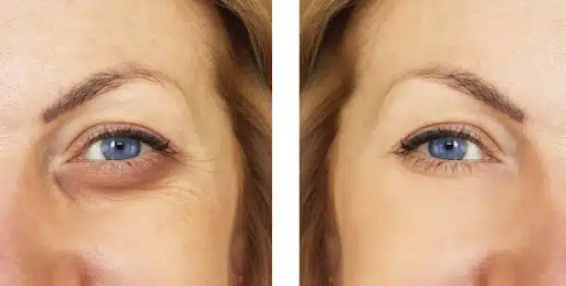 Under-Eye Bag Surgery - Say goodbye to tired eyes