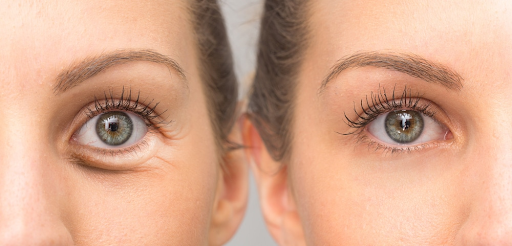Under-Eye Bag Surgery - Say goodbye to tired eyes