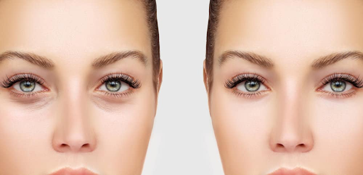 Upper Blepharoplasty: A complete guide to rejuvenating the upper eyelids