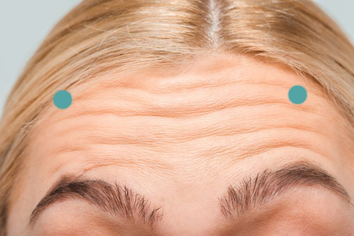 Spock eyebrow after botox injection: How can you correct that?
