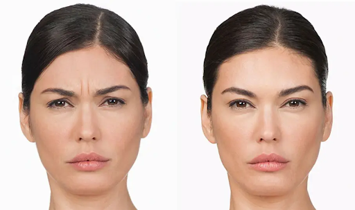 Spock eyebrow after botox injection: How can you correct that?