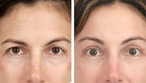 Spock eyebrow after botox injection: How can you correct that?