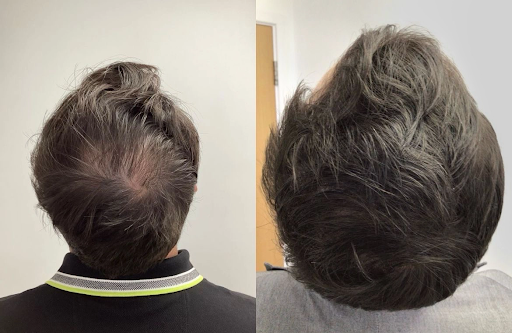 PRP for recovering hair loss - A comprehensive guide