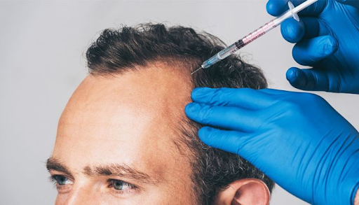 PRP for recovering hair loss - A comprehensive guide