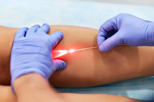 Varicose vein treatment by laser - Best solution for beauty