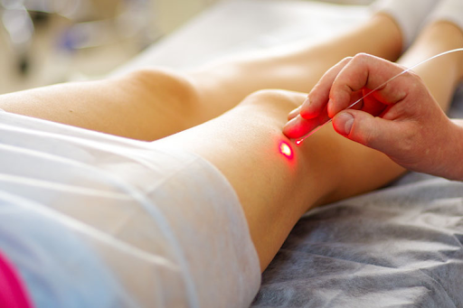 Varicose vein treatment by laser - Best solution for beauty