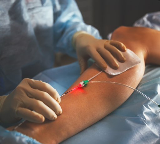 Varicose vein treatment by laser - Best solution for beauty